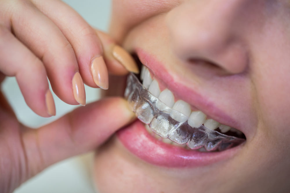 Dientes perfectos sin que se note