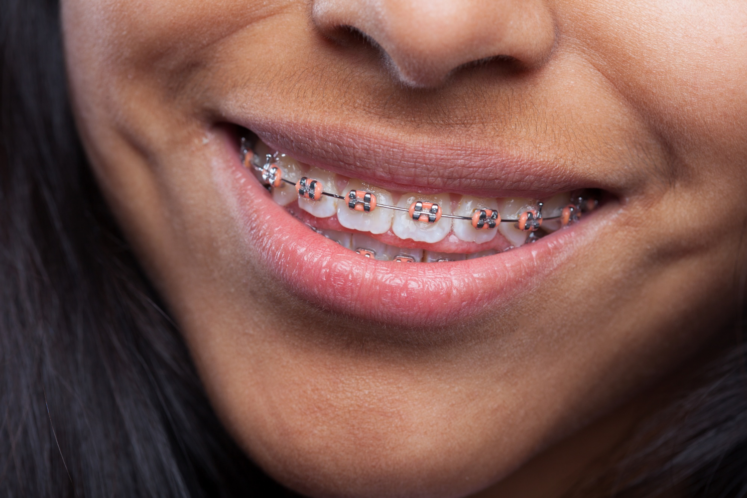 Lamine Yamal ha conseguido lo que ningún ortodoncista pudo lograr: que los brackets molen